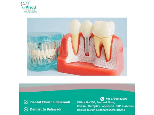 Dental Implants: What the Process Actually Involves