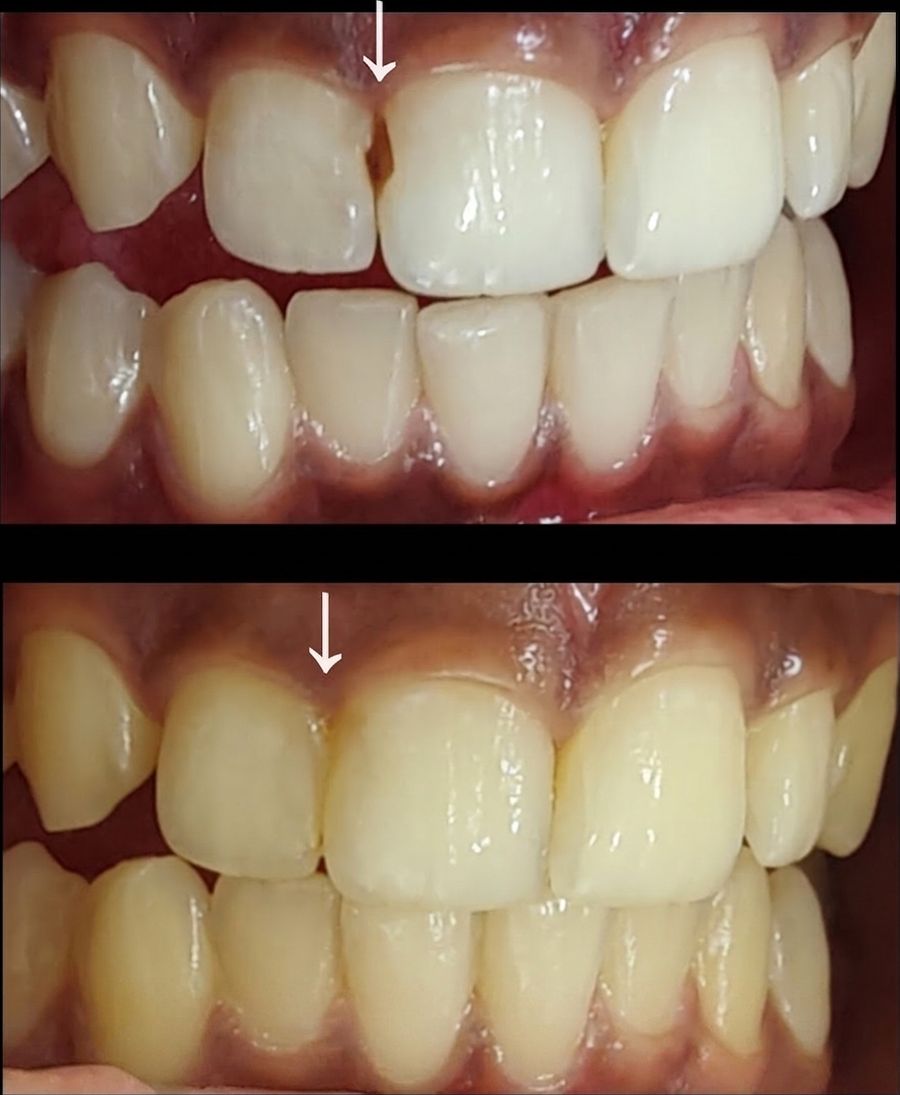 Spacing beside a front tooth closed, before and after, treated at Priva Dental and Wellness Clinic