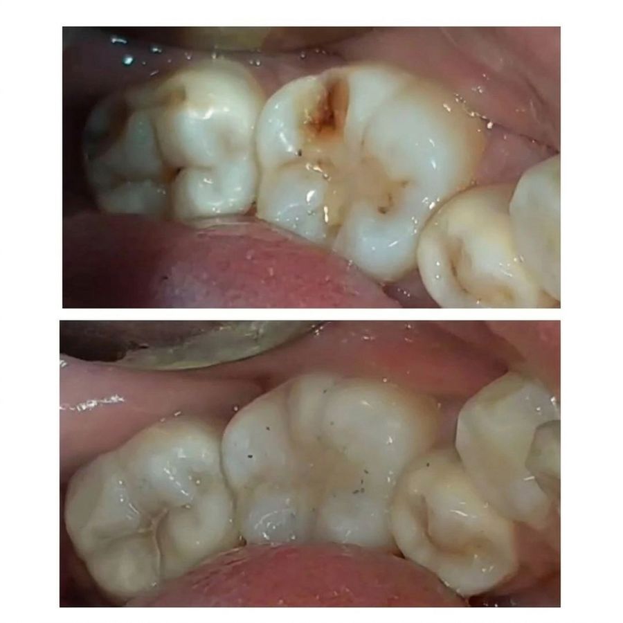 Cavity filled with tooth coloured composite, before and after, treated at Priva Dental and Wellness Clinic
