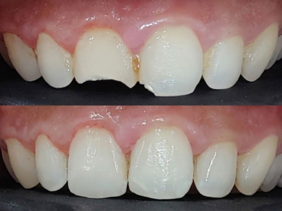 Chipped front teeth rebuilt, before and after, treated at Priva Dental and Wellness Clinic