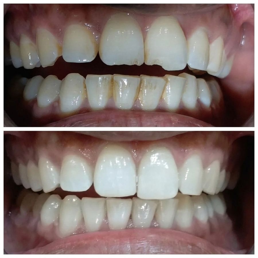 Staining and tartar cleared, before and after, treated at Priva Dental and Wellness Clinic