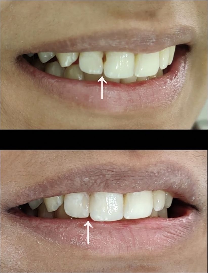 Gap between the front teeth closed, before and after, treated at Priva Dental and Wellness Clinic