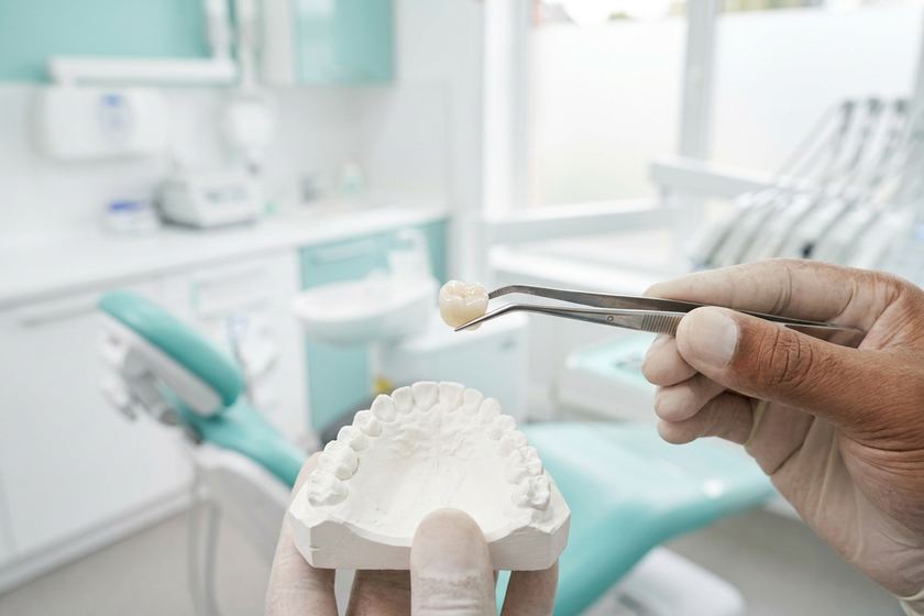 Zirconia dental crown held in tweezers above a plaster dental model