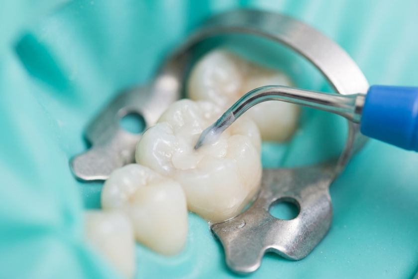 Molar being restored with tooth coloured composite under rubber dam isolation